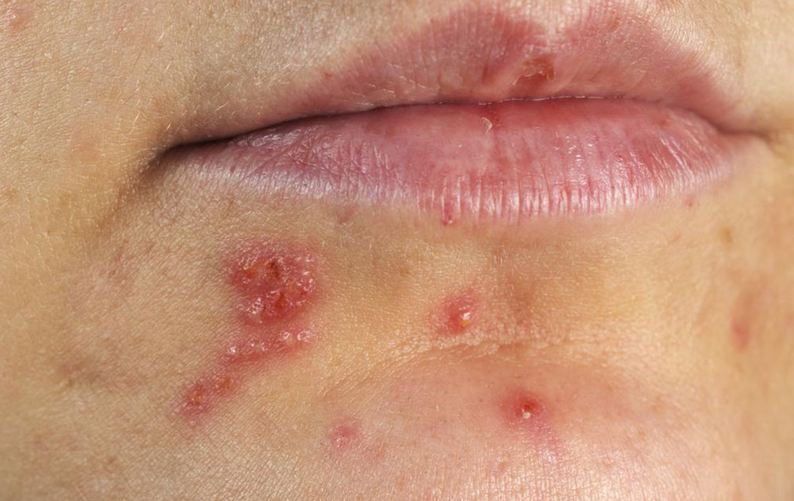 4 effective ways to treat herpes