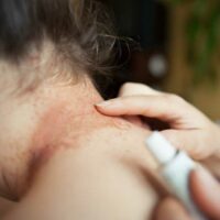 Common Signs and Symptoms of Eczema