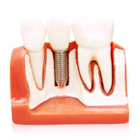 All you need to know about permanent dentures