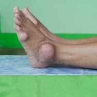 Gout attacks and their treatment procedures