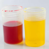 Definition, causes and symptoms of urine color