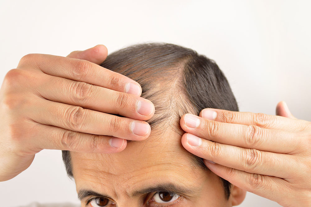 Hair loss – Its symptoms and causes