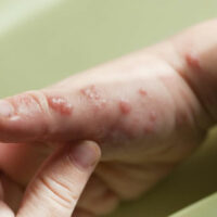 Treatment for symptoms of viral infections