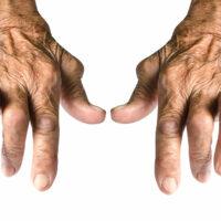 7 things to avoid to manage rheumatoid arthritis