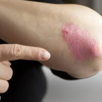 Chronic Plaque Psoriasis And its Effective Treatment