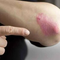 Easy Treatment Options to Cure Psoriasis