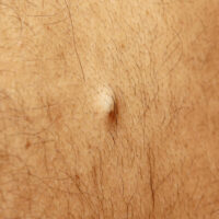 Facts and Signs of Ingrown Hair