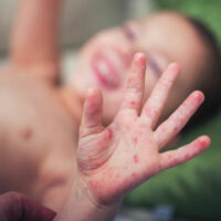 Find the Cure for Baby Eczema with the Right Creams