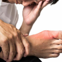 Symptoms and Treatments for Gout