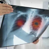 Symptoms and Treatments for Non-Small Cell Lung Cancer