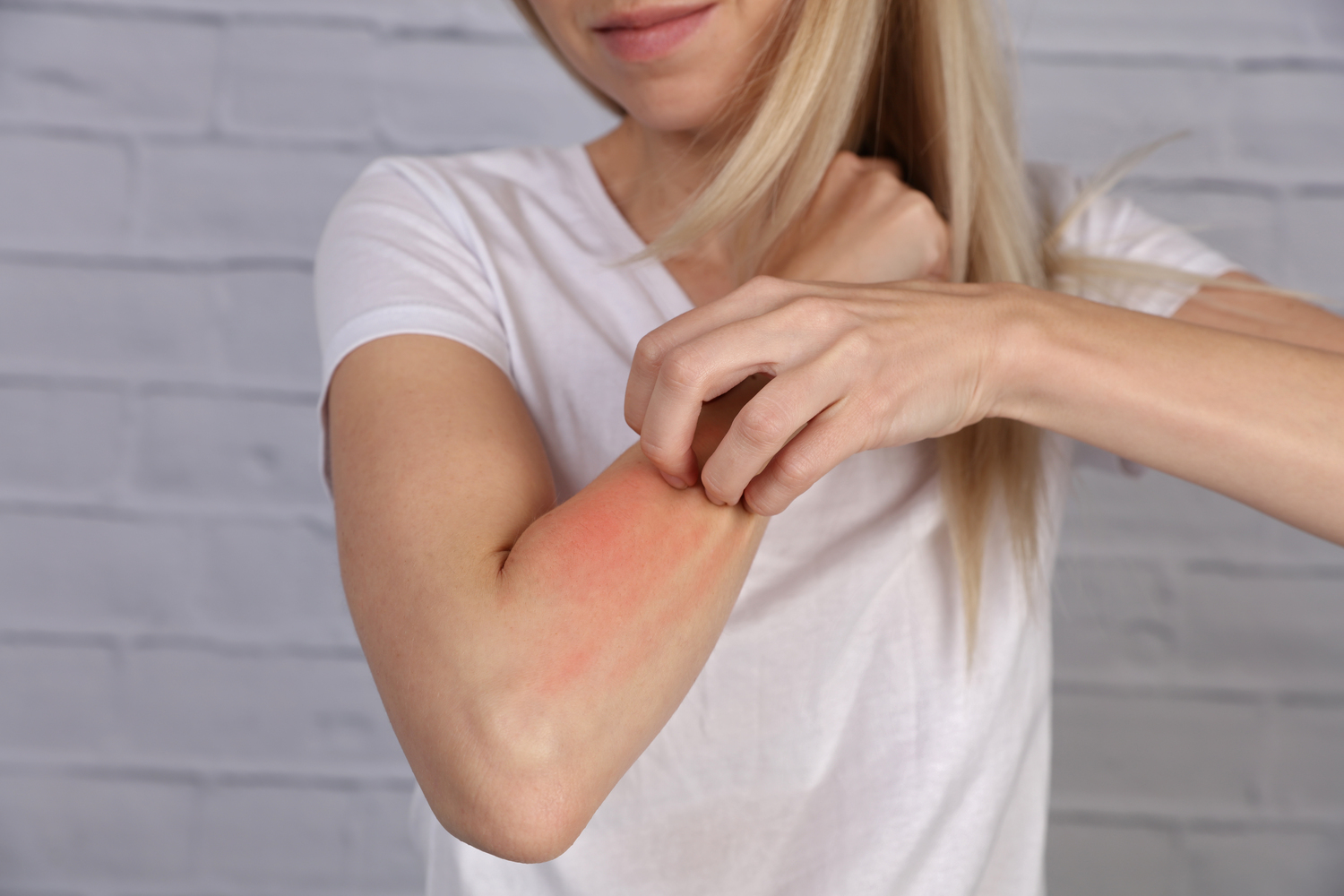 Psoriasis Medications And Their Side Effects