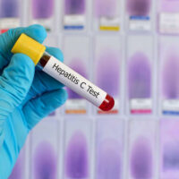 What to Expect from Hepatitis C Treatment