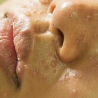 Treat Rosacea With These Natural Medicines and Remedies