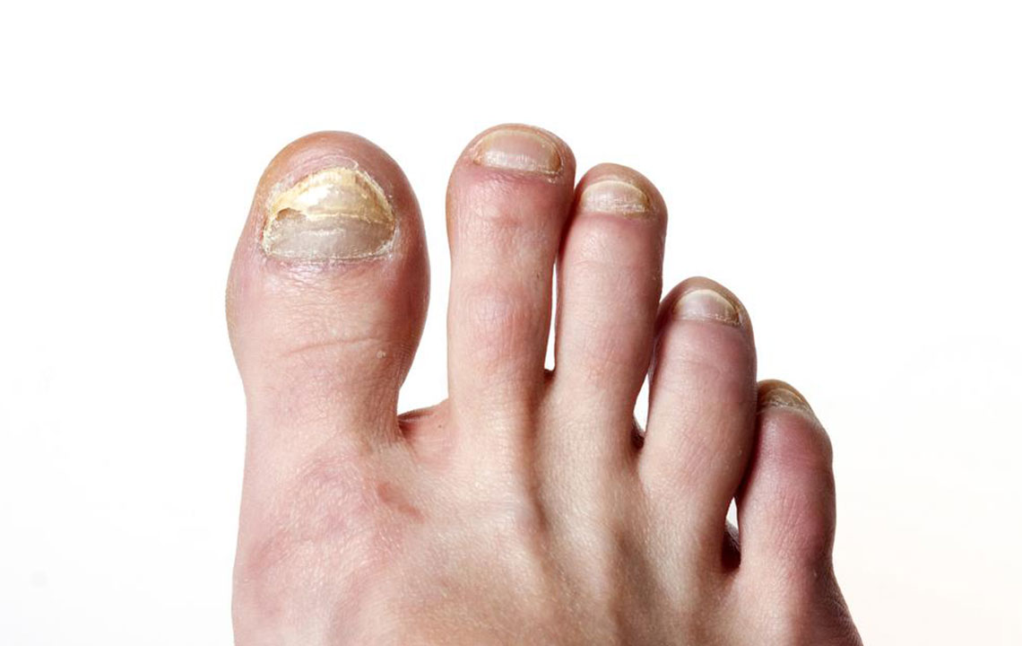 Tried and Tested Natural Cure for Toenail Fungus